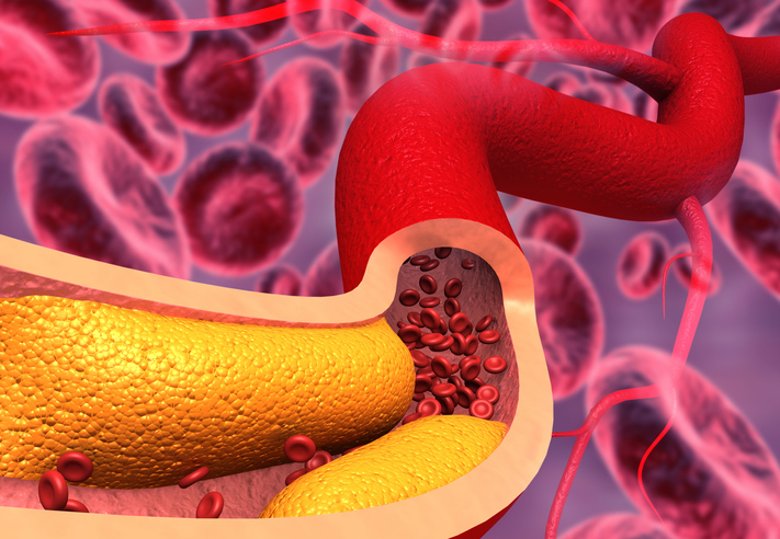 alimentación saludable para la hipertensión Nutricionistas expertos en colesterol alto
